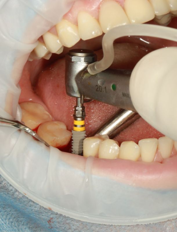 boca abierta y dentista poniendo implante 